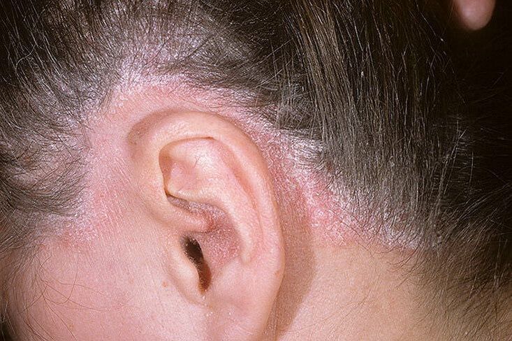 Ausbrüche von Psoriasis am Kopf hinter den Ohren