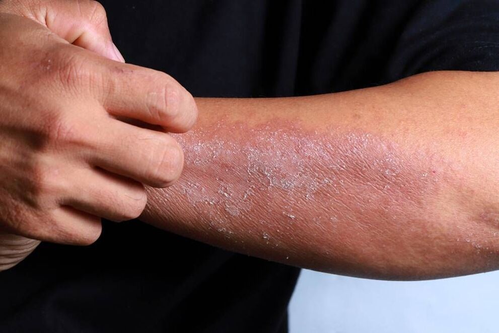 Psoriasis-Symptome der Haut