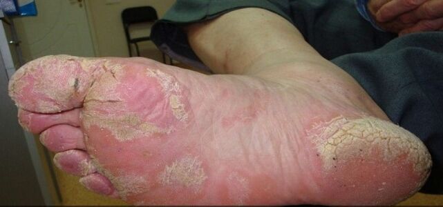 Psoriasis auf den Beinen