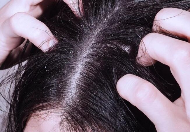 Psoriasis am Kopf