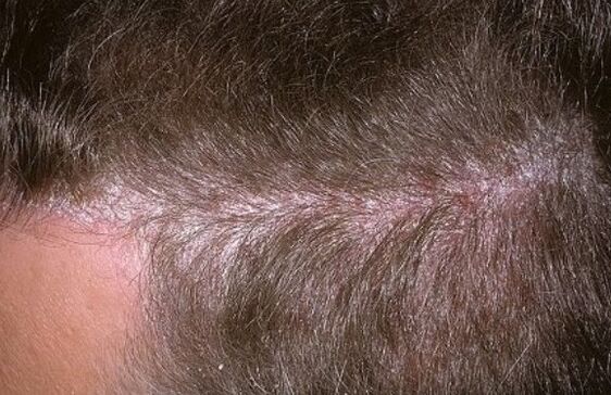 Psoriasis am Kopf
