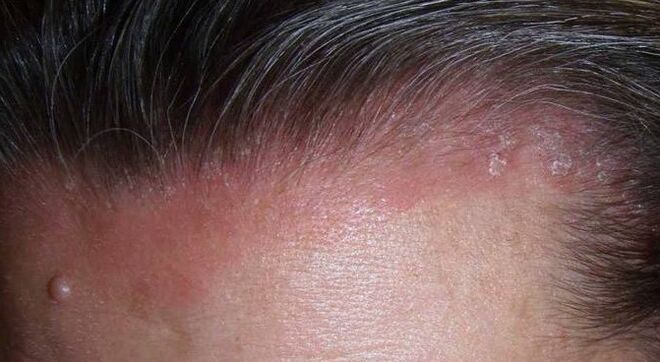 Was ist Psoriasis