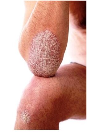 Psoriasis am Ellbogen
