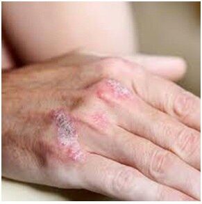Psoriasis auf dem Pinsel