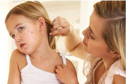 Psoriasis bei Kindern