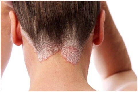 Psoriasis im Haar