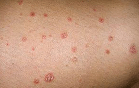 Psoriasis Plaques