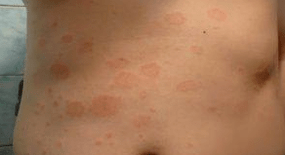 Unglückliche Psoriasis