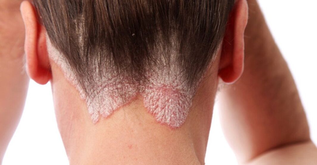 Psoriasis am Kopf der Mädchen