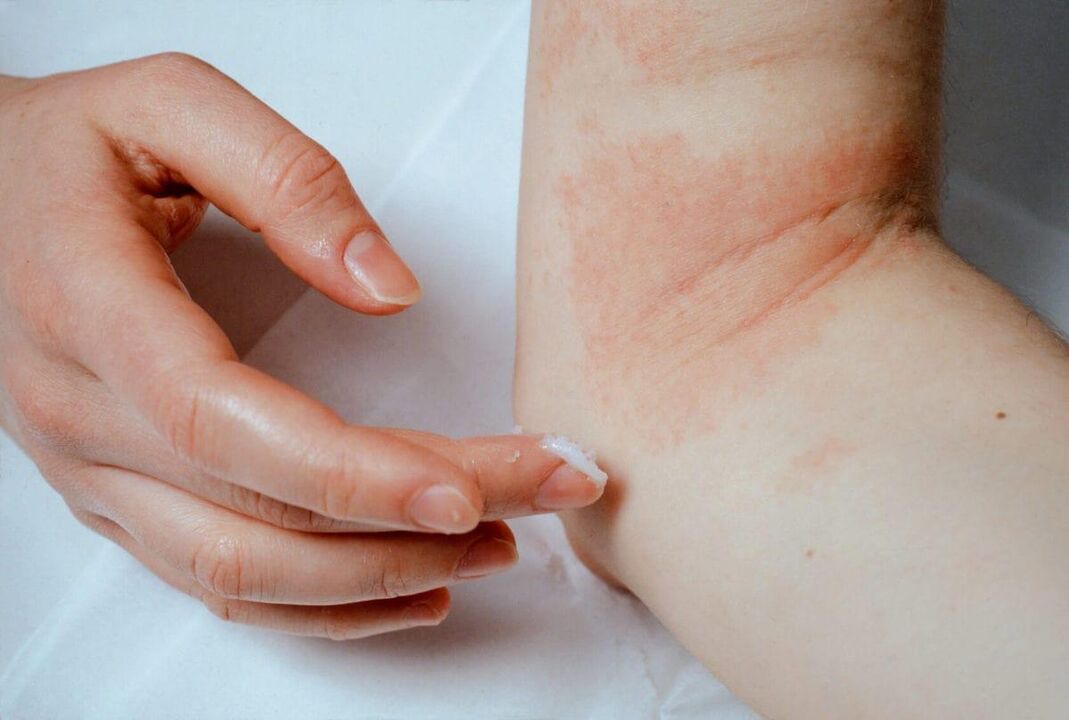 Behandlung von Psoriasis