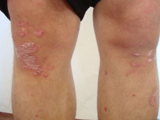Die Ursachen der Psoriasis