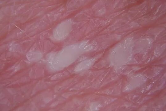 Pustulenien Psoriasis