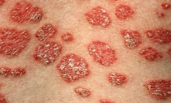 Formen der Psoriasis