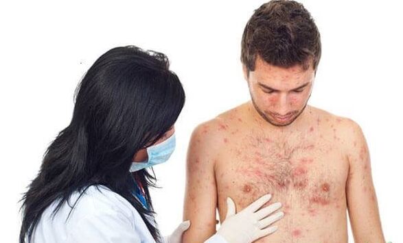 Psoriasis Foto