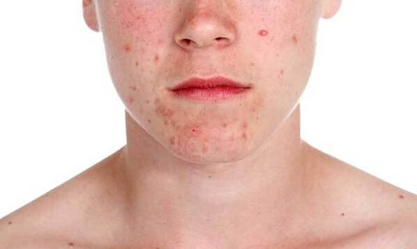 Symptome der Psoriasis