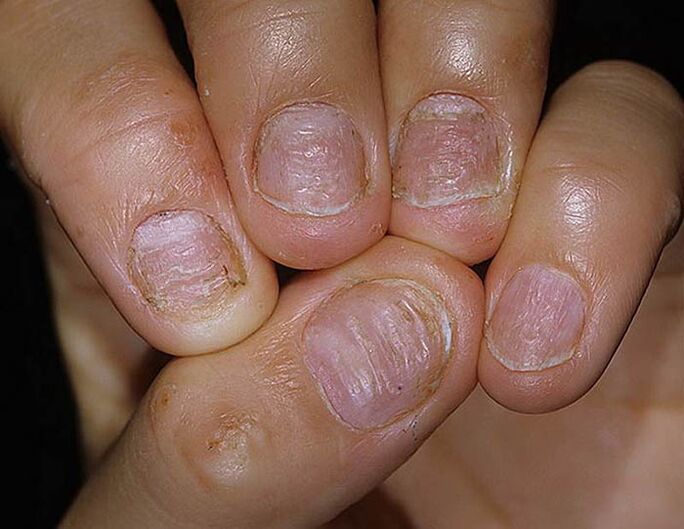 Psoriasis von Nägeln