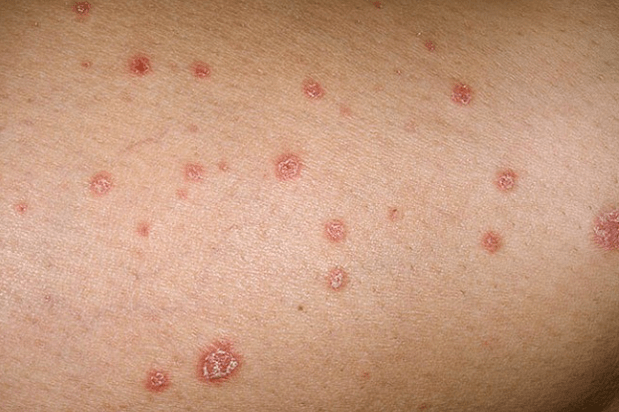 Psoriasis-Plaques