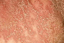 Pustelpsoriasis