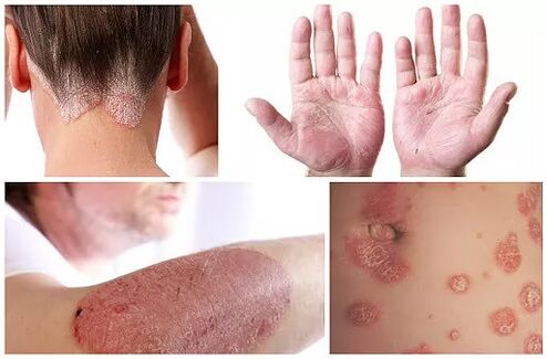 Manifestationen der Psoriasis an verschiedenen Körperstellen