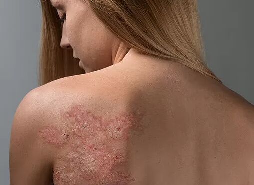 Psoriasis am Rücken eines Mädchens