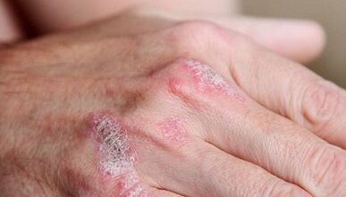 Symptome des Anfangsstadiums der Psoriasis