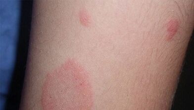 Wie äußert sich das Anfangsstadium der Psoriasis
