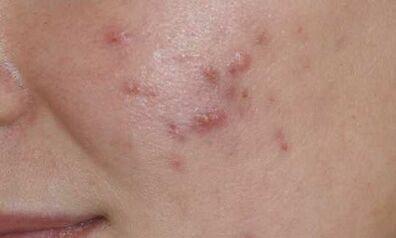 Symptome des Anfangsstadiums der Psoriasis