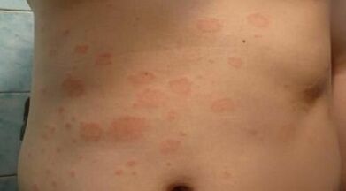 Wie erkennt man das Anfangsstadium der Psoriasis