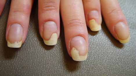Weiße Flecken auf den Nägeln aufgrund von Psoriasis