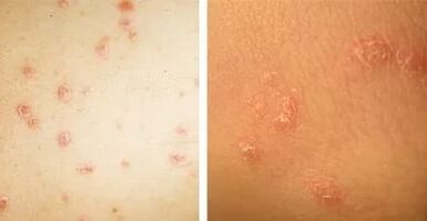 Haupterscheinungen der Psoriasis