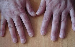 Symptome einer Psoriasis im Anfangsstadium