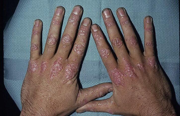 Gründe für die Entwicklung einer Psoriasis an den Händen