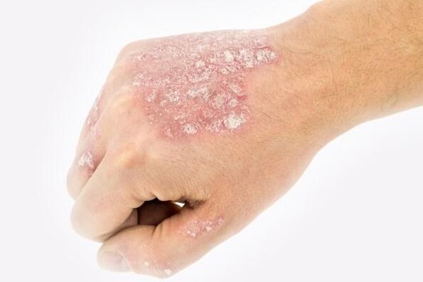 Mechanismus der Entwicklung von Psoriasis an den Händen