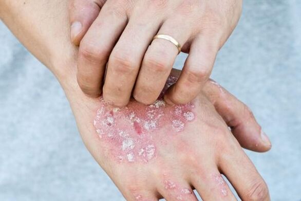 charakteristische Symptome der Psoriasis an den Händen