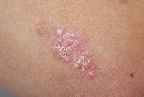 Psoriasis-Plaque auf der Haut
