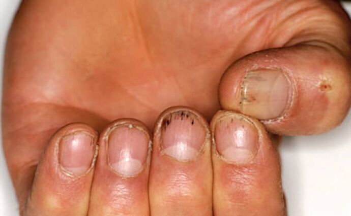 Blutung unter den Nägeln mit Psoriasis
