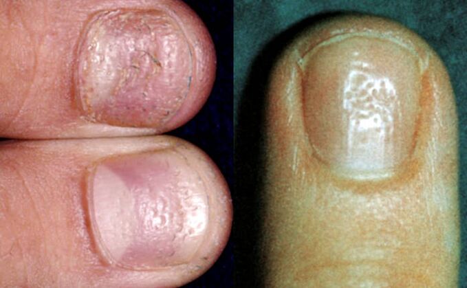 Fingerhut-Symptom - mehrere Vertiefungen auf der Oberfläche der Nagelplatte