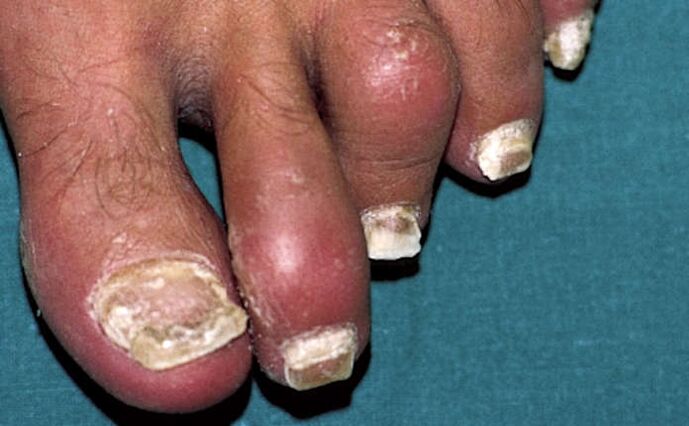 Psoriasis mit Nagelbeteiligung und Gelenkentzündung (Arthritis) der Zehen